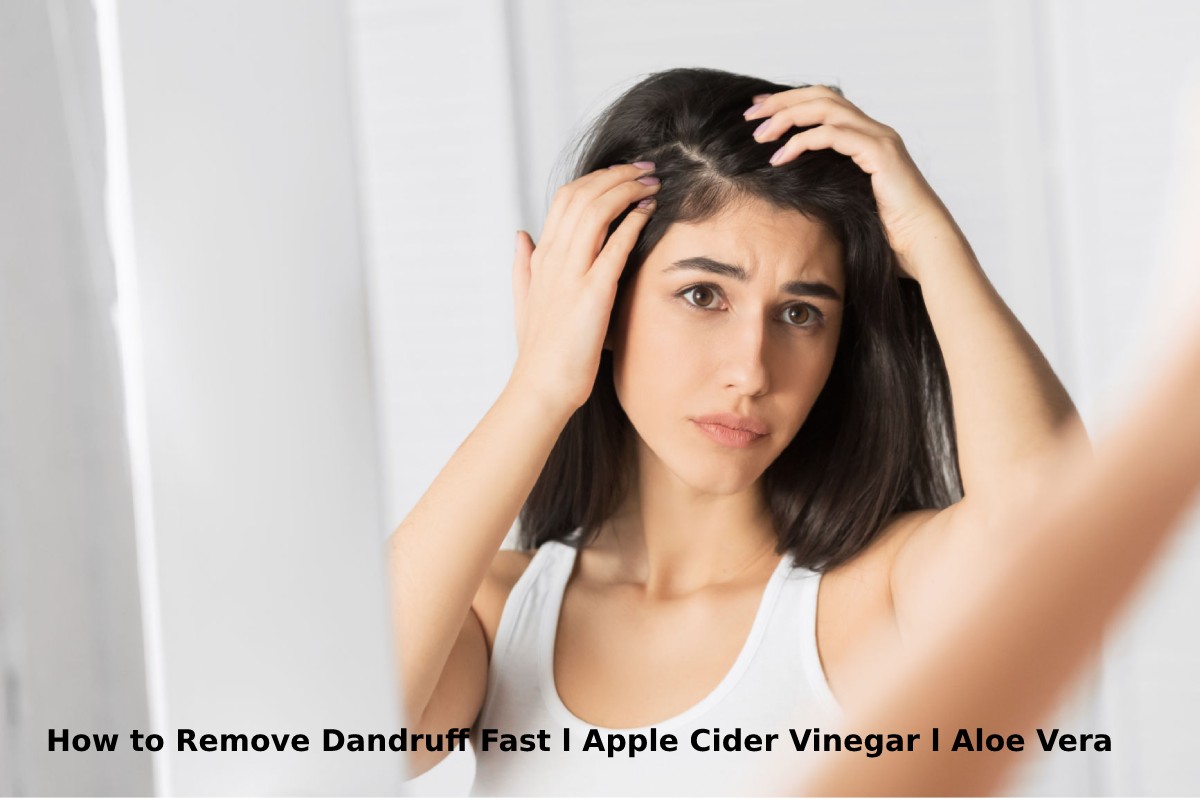 How to Remove Dandruff Fast l Apple Cider Vinegar l Aloe Vera