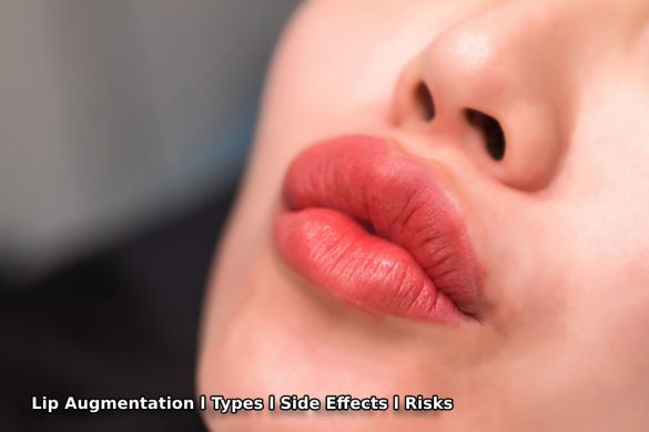 Lip Augmentation