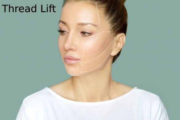 Thread Lift