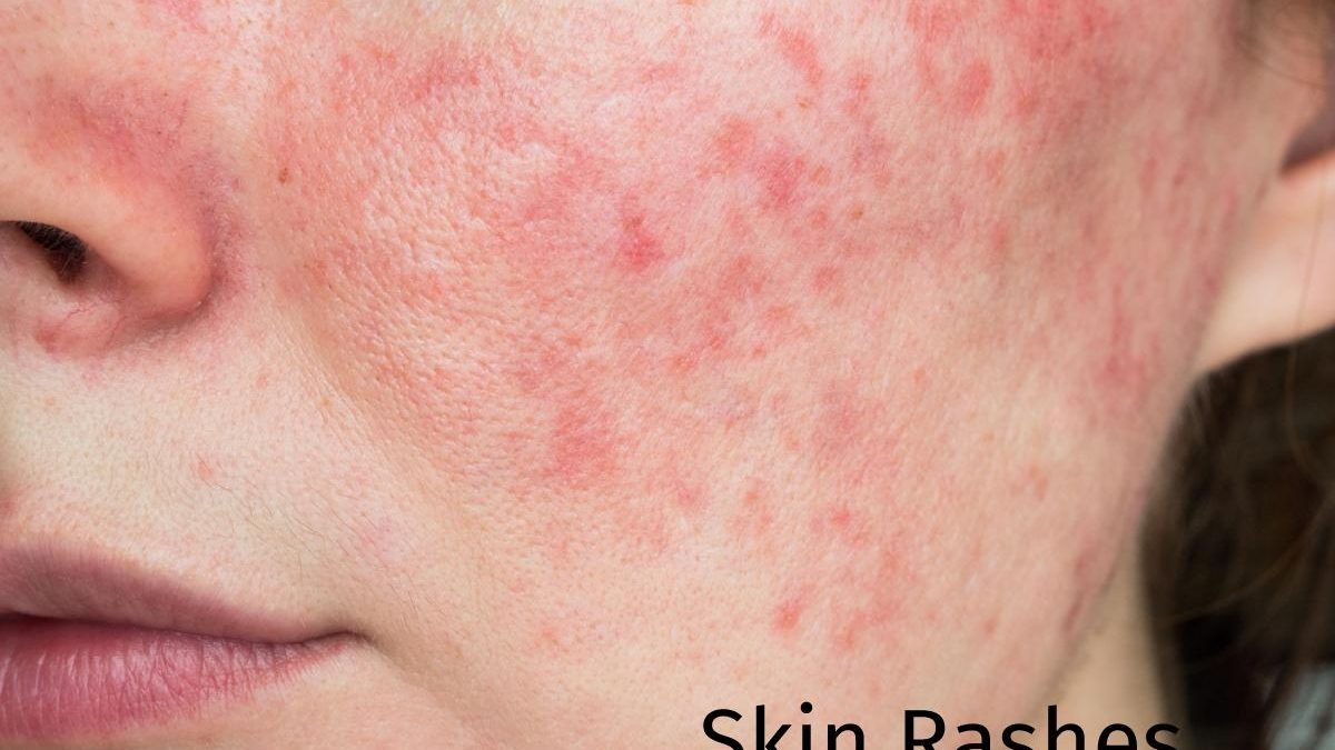 Skin’s Rashes – Stress And Other Different Reasons