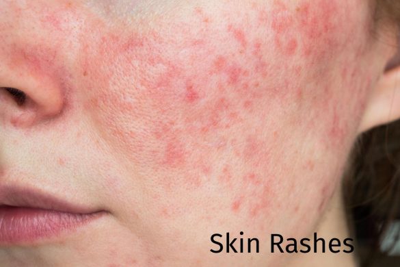 skin rashes