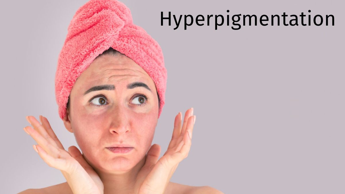Hyperpigmentation – Types Of Treatment And Routine