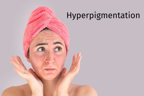 Hyperpigmentation