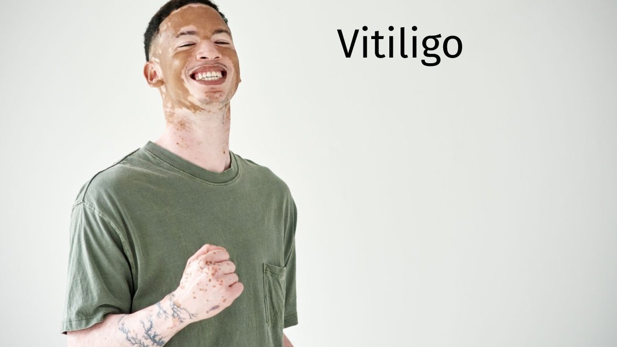 Vitiligo – The White Spot Disease