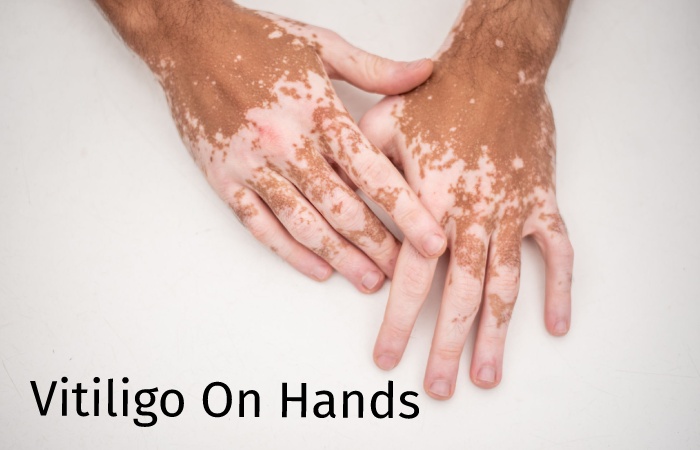 Vitiligo