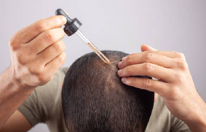 Usage of Minoxidil