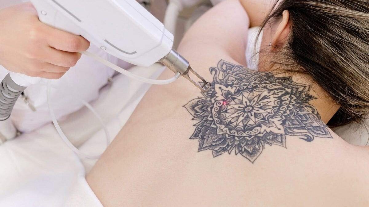 The Art of Erasure: Strategies for Tattoo Removal Success