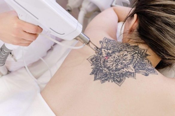 The Art of Erasure_ Strategies for Tattoo Removal Success