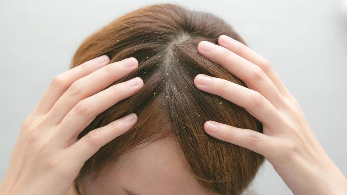 Dandruff: What Is Dandruff, Causes Of Dandruff, And How To Get Rid Of It