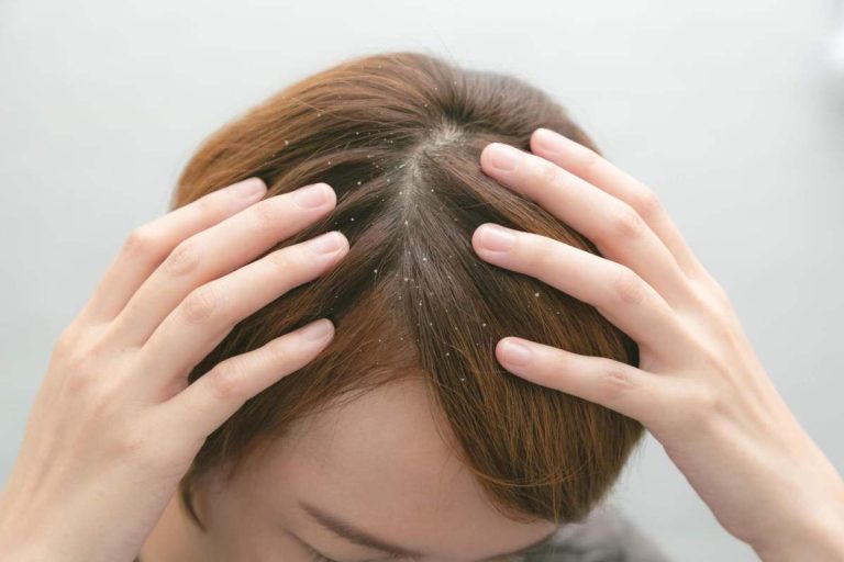 Dandruff: What Is Dandruff, Causes Of Dandruff, And How To Get Rid Of It