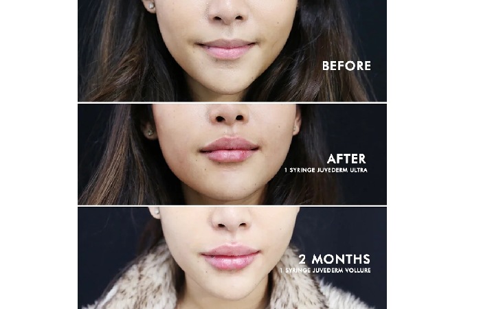 lip augmentation